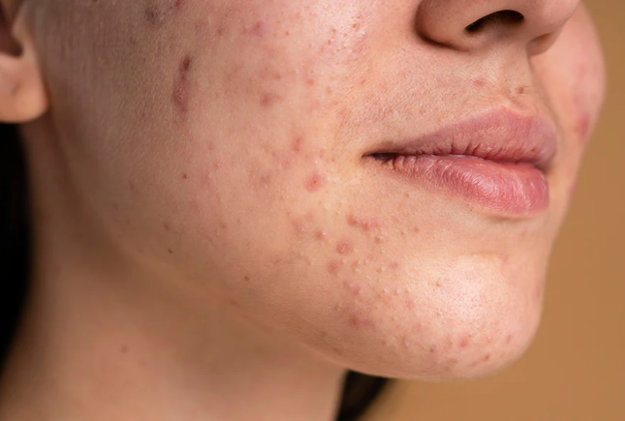 The Complete Guide to Pigmentation on Face Diet!